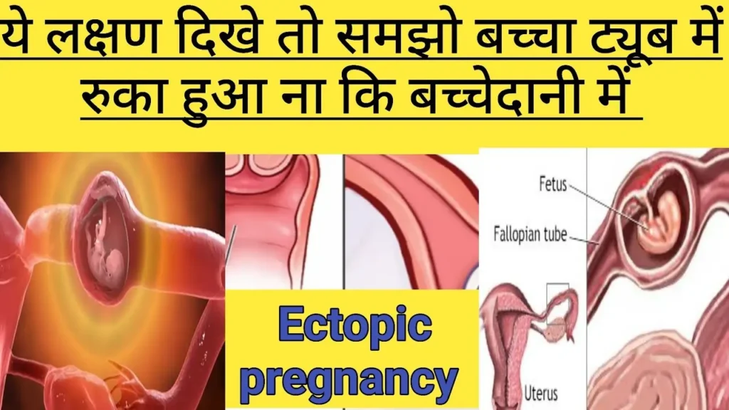 Ectopic Pregnancy Ki Vajah Kya Hoti Hai?