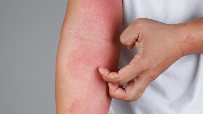 4 Ways to Treat Your Skin Allergy