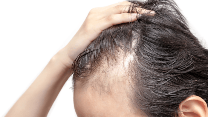 Alopecia Treatment at Home अगर हां तो ये लक्षण alopecia यानि severe hair loss के हो सकते हैं। आज हम आपको alopecia के कारण,