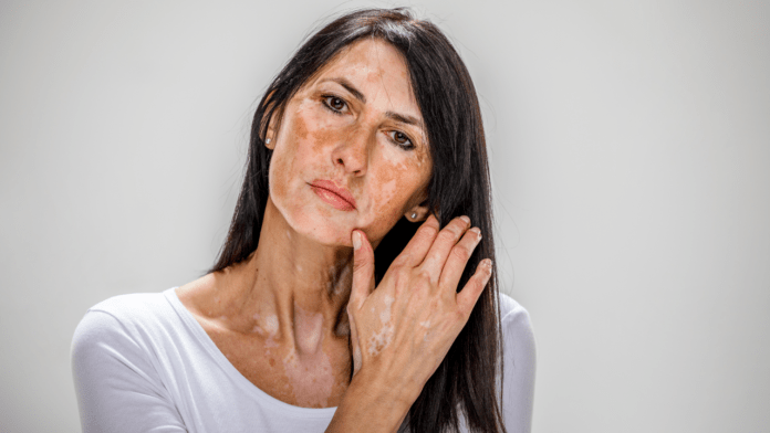 Vitiligo Symptoms And Treatment