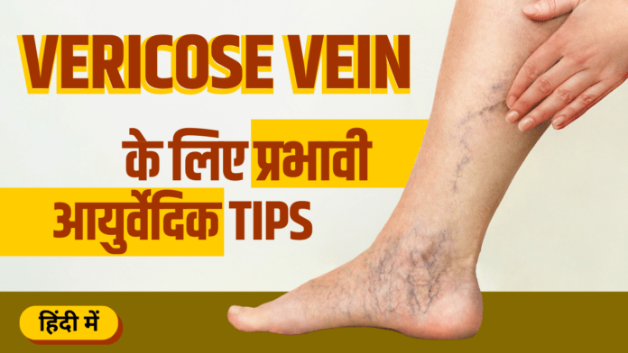 Varicose treatment in Ayurveda