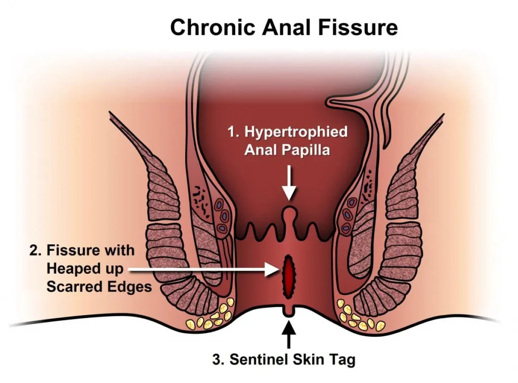 Causes of Fissures